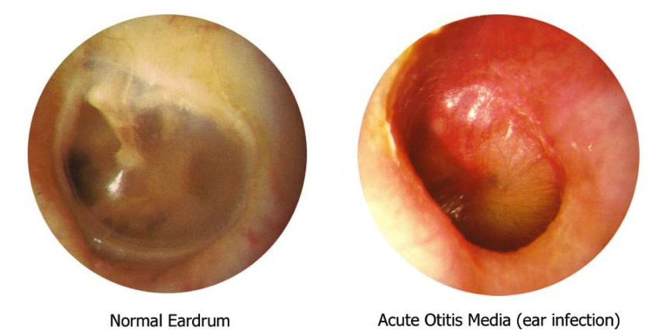 how to clear a clogged ear after an ear infection