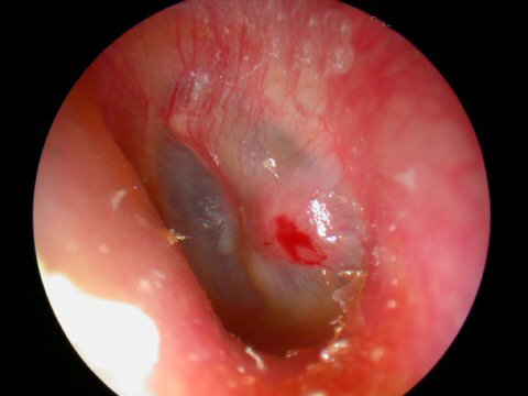 how to clear a clogged ear after an ear infection