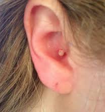 how to clear a clogged ear after an ear infection